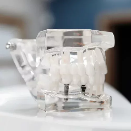 Implantes dentales